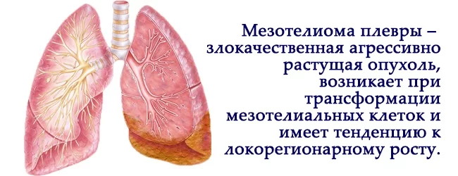 mezotelioma-plevry-prichiny-simptomy-diagnostika-i-lechenie